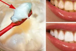 Reverse Cavities And Heal Decomposed Teeth With Coconut Oil