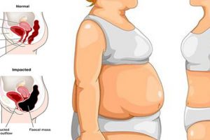 causes of stomach bloat