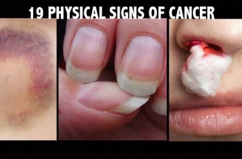 19 Signs Of Cancer That Most People Neglect