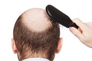 Hair Growth Discovery Could Help Scientists Develop Effective Treatment For Hair Loss