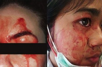 Woman Mysteriously “Sweats” BLOOD From Face And Hands