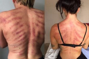 Can You Guess What Job Gave This Woman These Horrific Marks?