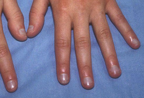 blue fingernails
