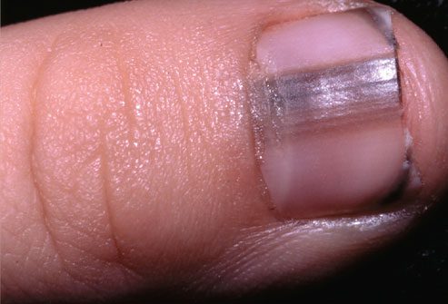 dark lines finger nails