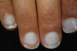 This Is What The Color Of Your Fingernails Reveals About Your Health