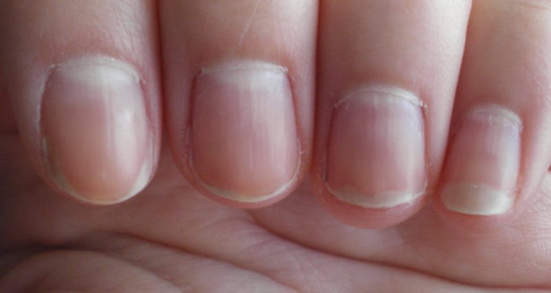 pale fingernails