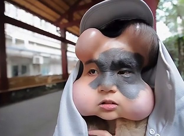 Woman With Giant Birthmark Has Egg-Like Devices Inserted Under Skin