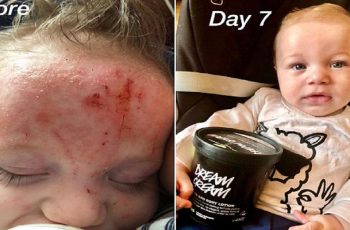 Mother Cured Her Baby’s Eczema With Lush’s Dream Cream