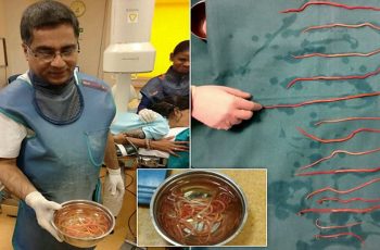 Footage Shows Surgeons Removing 14 Worms From A Woman’s Organs
