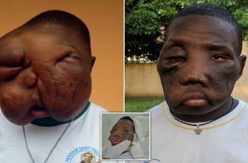 Incredible Transformation Of Cancer Teen Whose Facial Tumor