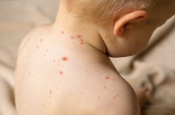 Colorado Parents Are Holding ‘Chickenpox Parties’ To Infect Their Kids