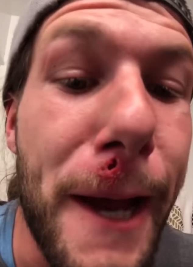 man removes cyst in top lip
