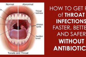 throat infection home remedies