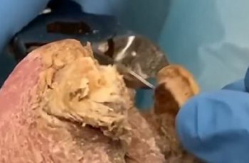Podiatrist Shares Stomach-Churning Video Footage Cutting Away Patient’s Thick Infected Toenails