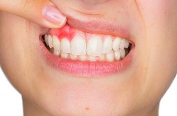 10 Easy Ways to Heal Receding Gums Naturally