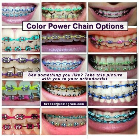 power chain braces
