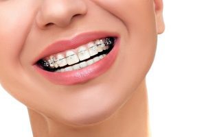 The Best Products for Whitening Teeth With Braces