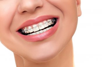whitening teeth with braces