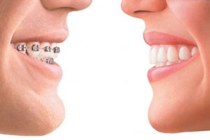 Here’s How to Tell Overbite vs Normal Teeth Bite