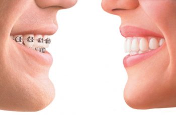 Here’s How to Tell Overbite vs Normal Teeth Bite