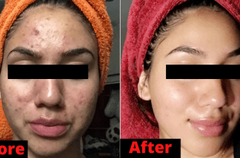 4 Natural Remedies For Acne