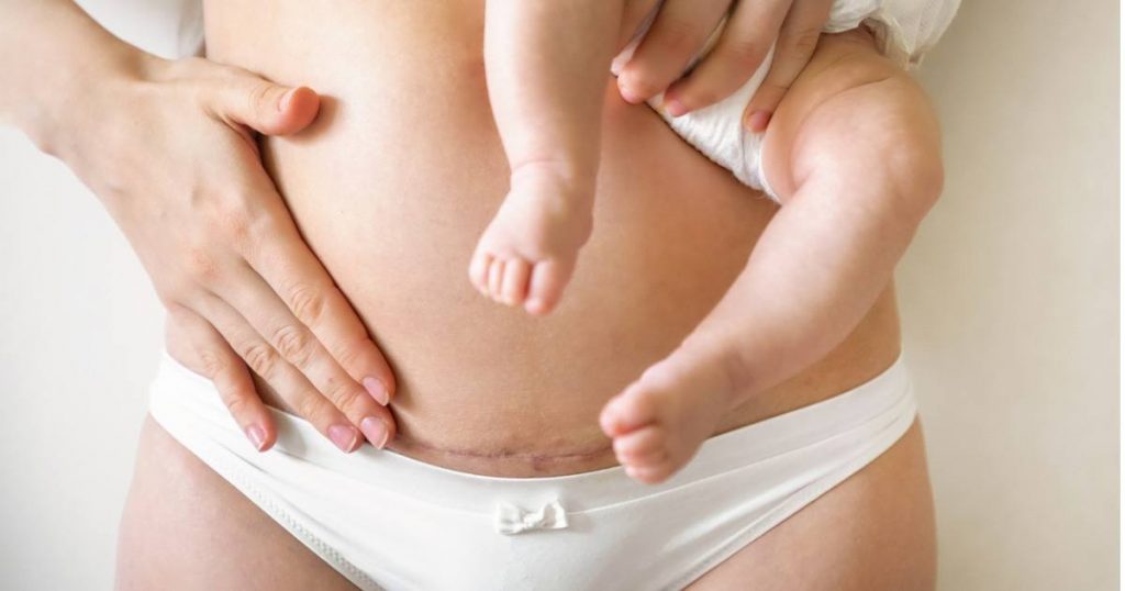 how to get rid of hanging belly after c section
