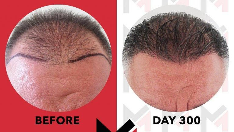 scalp micropigmentation regrets