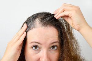 7 Types of Female Hair Loss
