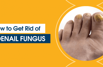 How to Get Rid of Toenail Fungus