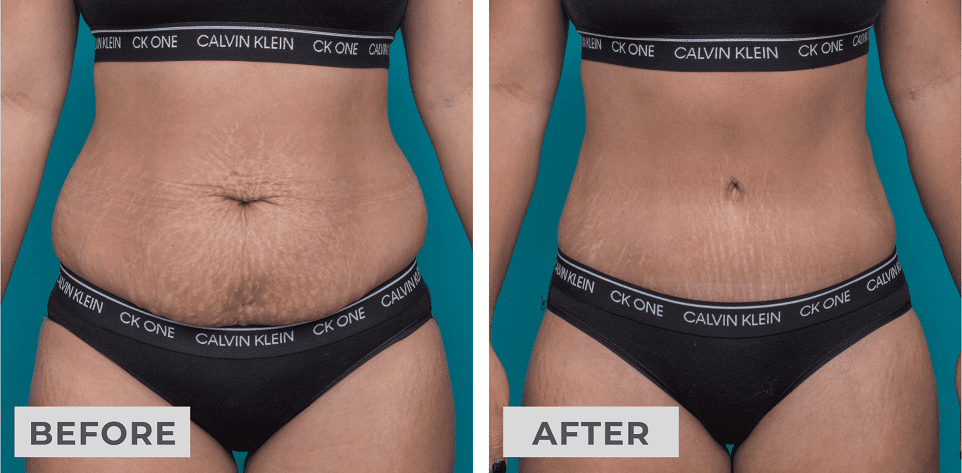 stretch marks after weight loss