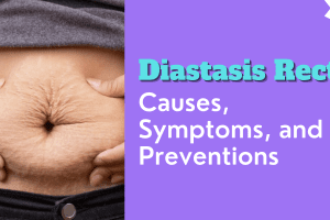 Diastasis Recti: Causes, Symptoms, and Preventions 2022