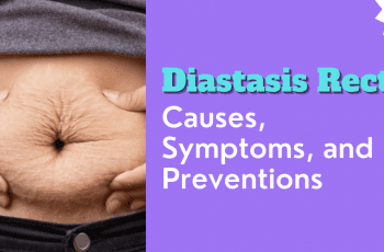 Diastasis Recti: Causes, Symptoms, and Preventions 2022