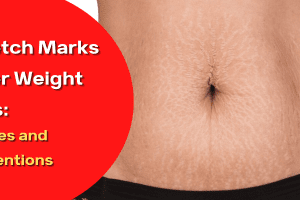 Stretch Marks After Weight Loss: Causes and Preventions 2022