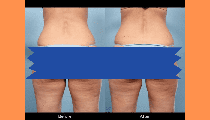 Coolsculpting Outer Thighs