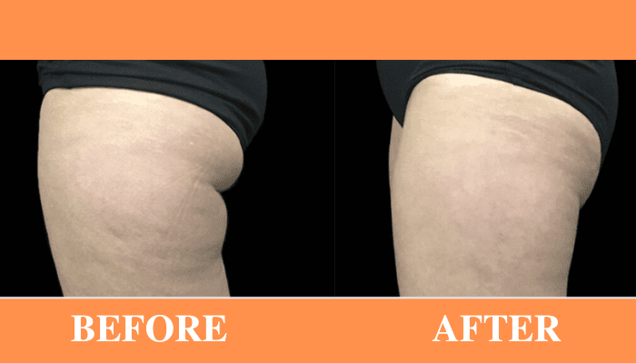 Coolsculpting Outer Thighs