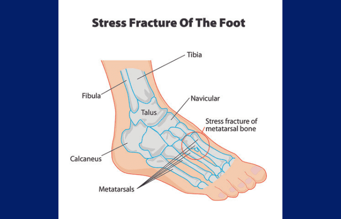 Do stress fractures heal on their own
