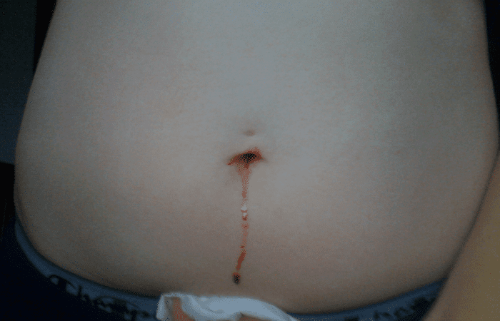 Why is my belly button bleeding and smelly