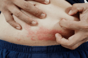Why You Might Have a Rash Under Belly Fat