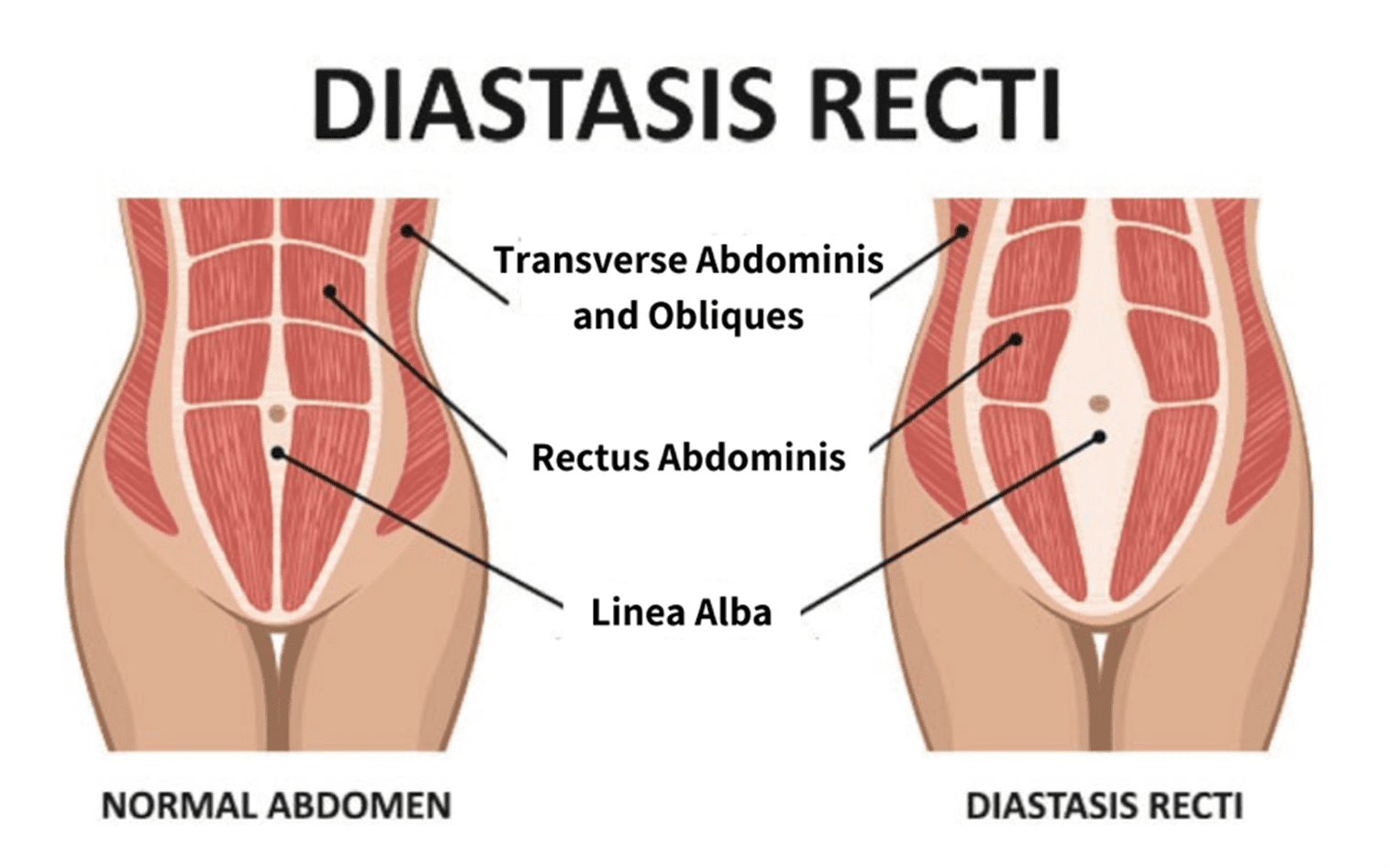Diastasis recti exercises
