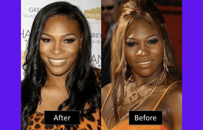 Serena williams plastic surgery