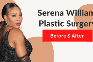 Serena williams plastic surgery