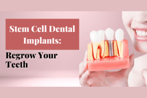 Stem Cell Dental Implants: Regrow Your Teeth 2022