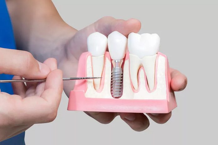 Stem cell dental implants