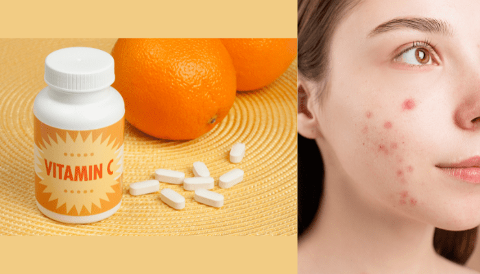 Does vitamin c help acne