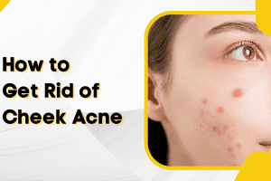 How to Get Rid of Cheek Acne