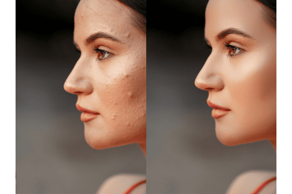 How to Get Rid of Cheek Acne