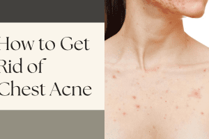 How to Get Rid of Chest Acne 2022
