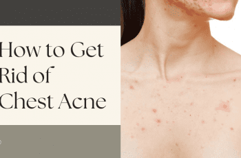 How to get rid of chest acne
