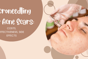Microneedling for Acne Scars: Costs, Effectiveness, Side Effects 2022