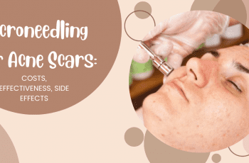 Microneedling for Acne Scars: Costs, Effectiveness, Side Effects 2022